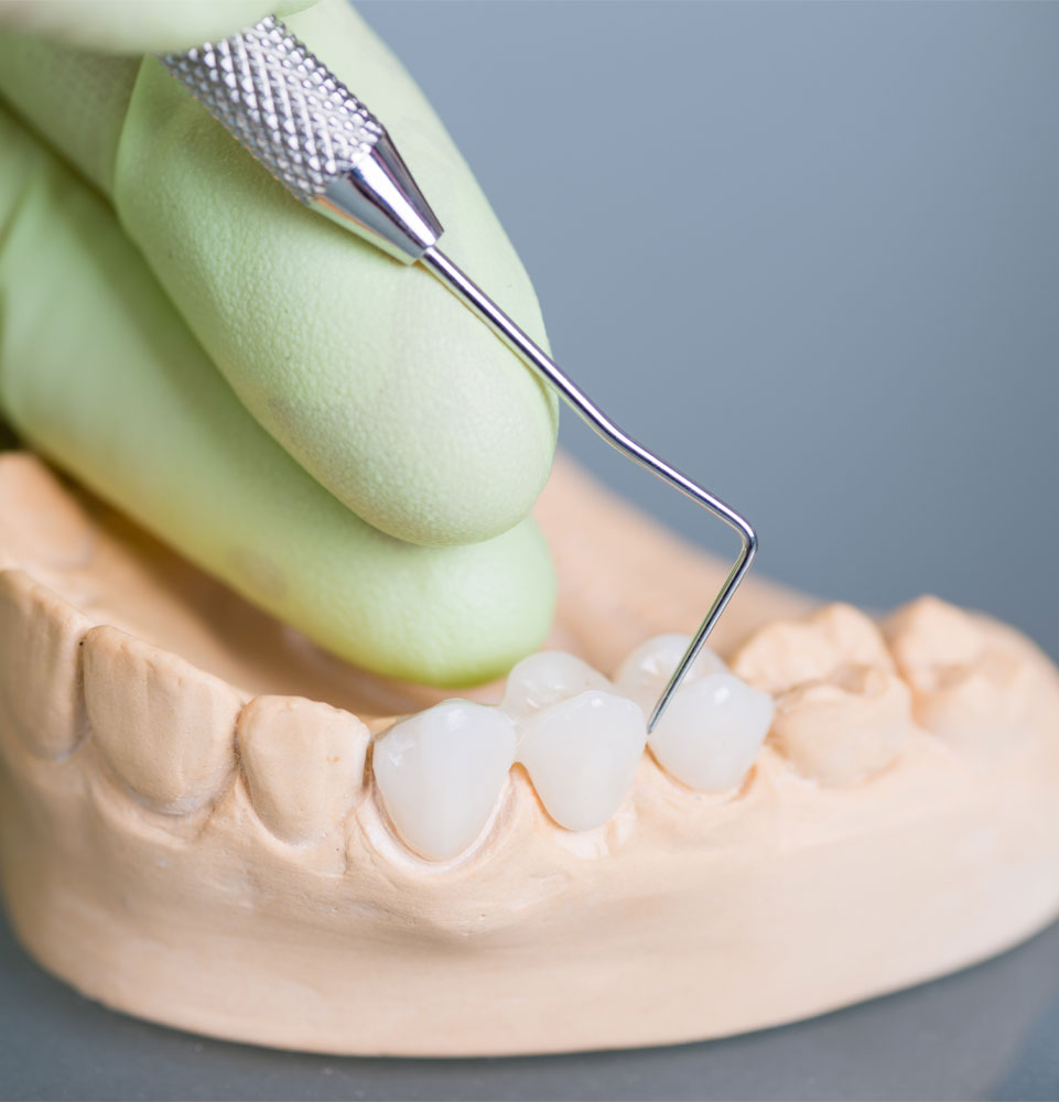 dental bridge model