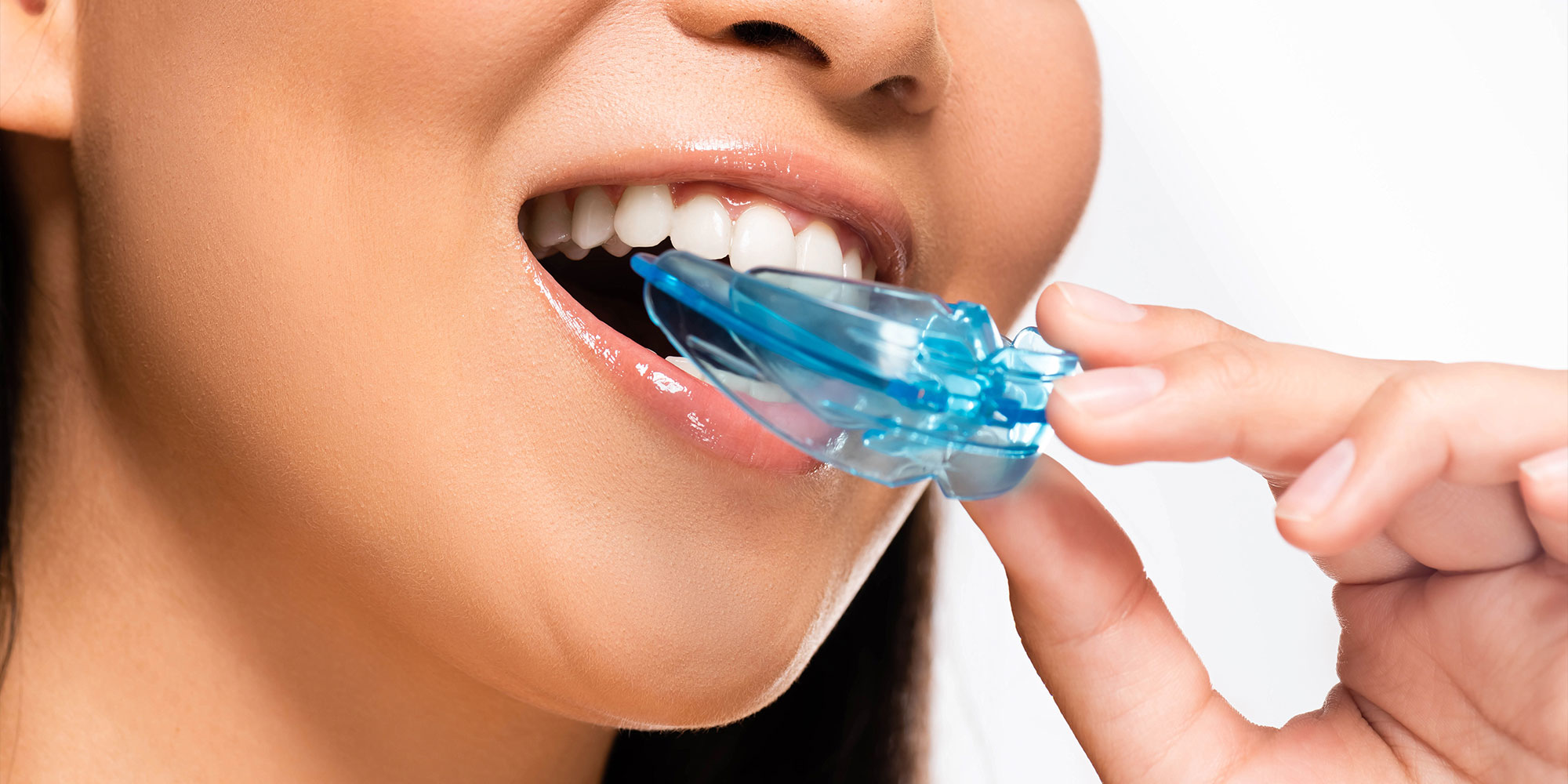 dental mouthguard