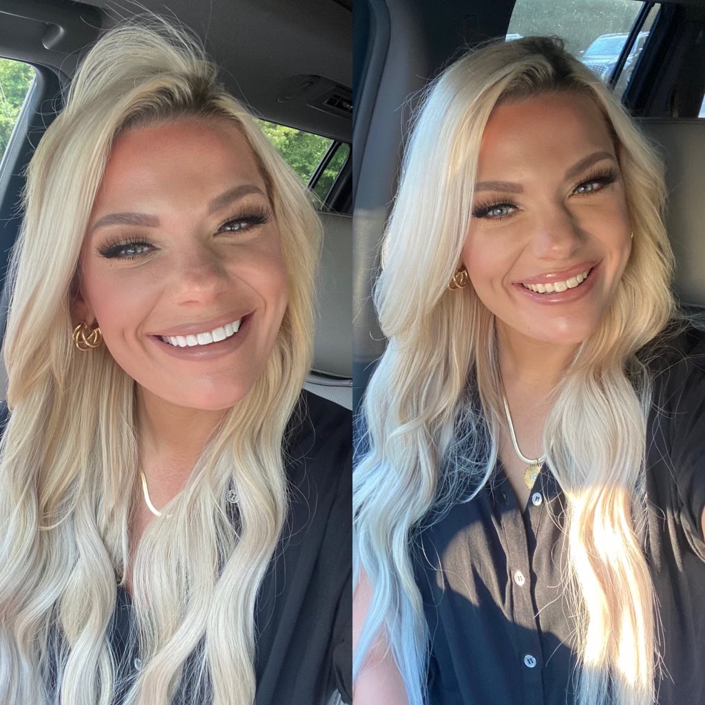 Porcelain Veneers before and after